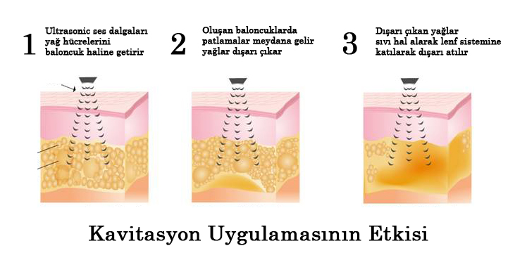  Kavitasyon Nasıl Etki Eder